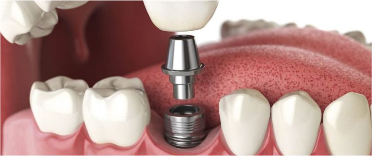 İmplant Tedavisi